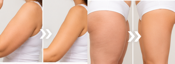 Arms and thighs areas