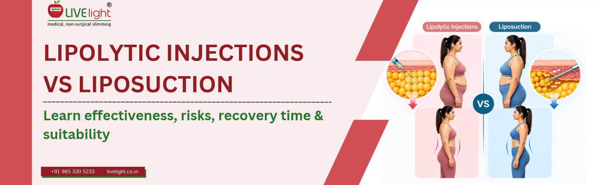 Lipolytic Injections vs Liposuction: Which Is Right for You?