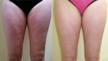U-Lipo Result 2