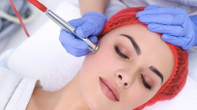 Microdermabrasion Treatment