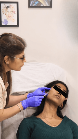 Thread lift treatment procedure at livelight Thane