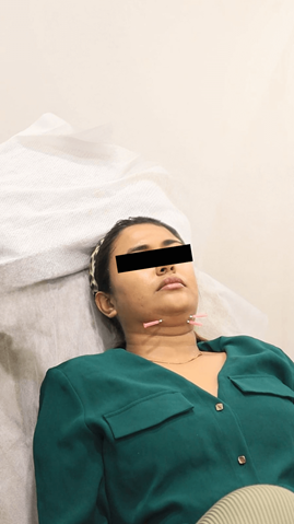 Thread lift treatment procedure at livelight Thane